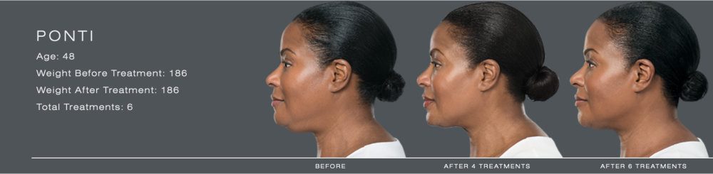 kybella for double chin img