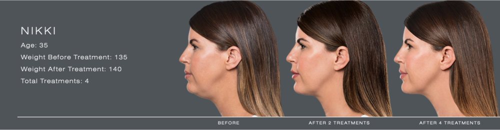 kybella for double chin