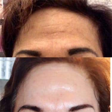 Lightening Peel before and after