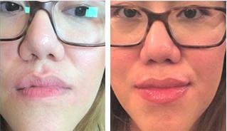 Lip Rejuvenation Treatment