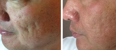 PRP for Acne Scars and Rejuvenation