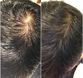 PRP Hair Restoration Treatment