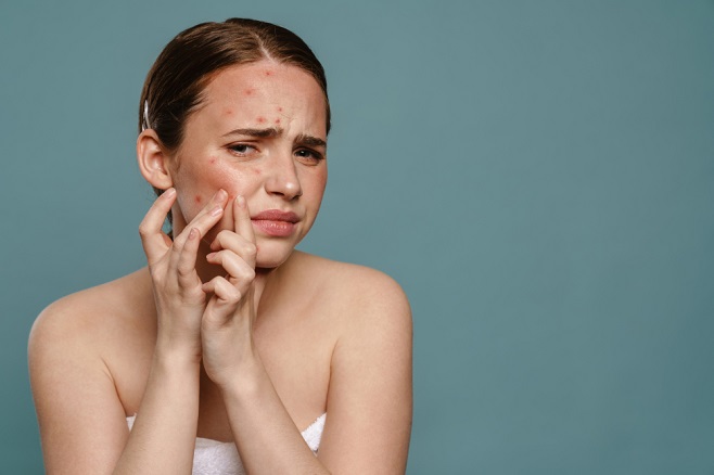 proven-care-tips-for-acne-prone-skin