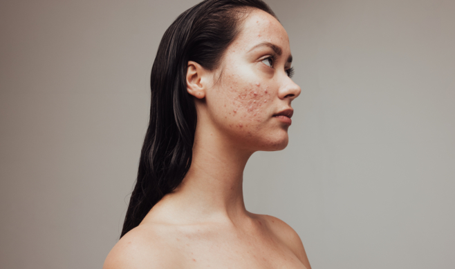 prescriptive-and-non-prescriptive-treatment-for-acne