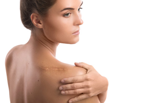 understanding-keloid-scars-prevention-and-removal